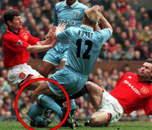 Hậu vệ David Busst (Coventry City) gãy gập chân sau pha va chạm với hai cầu thủ Man Utd là Denis Irwin và Brian McClair năm 1996.